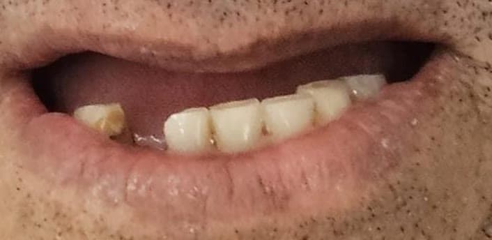 Close da boca antes: dentes remanescentes desgastados e ausências na arcada