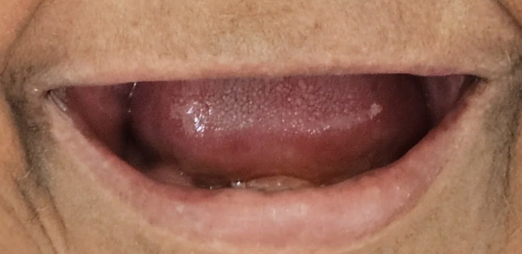 Close da boca antes: arcadas sem dentes