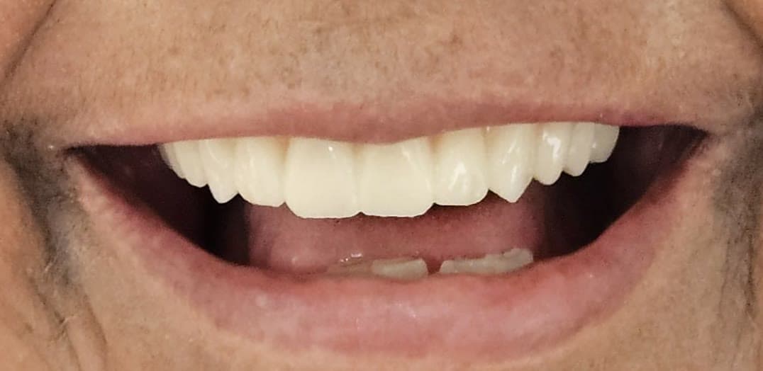 Close da boca depois: sorriso reabilitado com prótese total